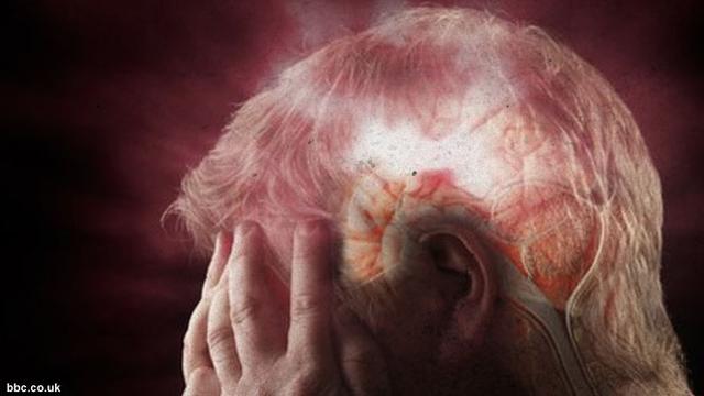 6 Cara Mudah Terhindar dari Serangan Stroke