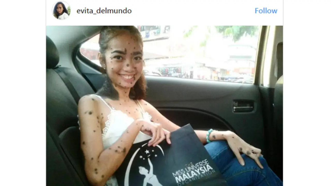 tahi lalat miss universe