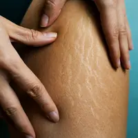 Ilustrasi stretch mark/copyright shutterstock/Yanya