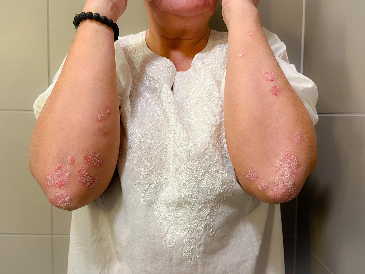 Psoriasis