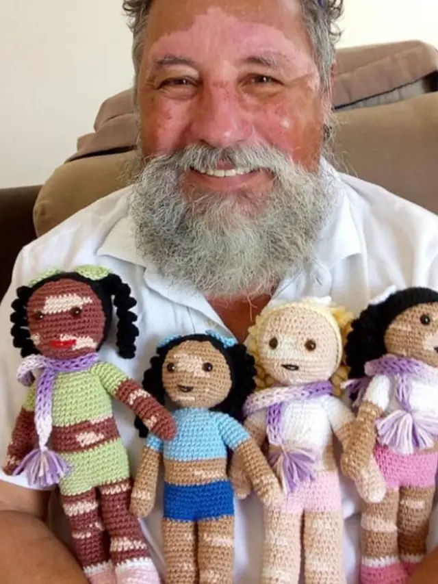 Meningkatkan PD Anak-Anak dengan Vitiligo, Pria Ini Buat Boneka Rajut Unik