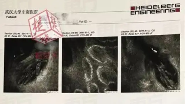 Jarang Ganti Sarung Bantal, Tungau Bersarang di Bulu Mata