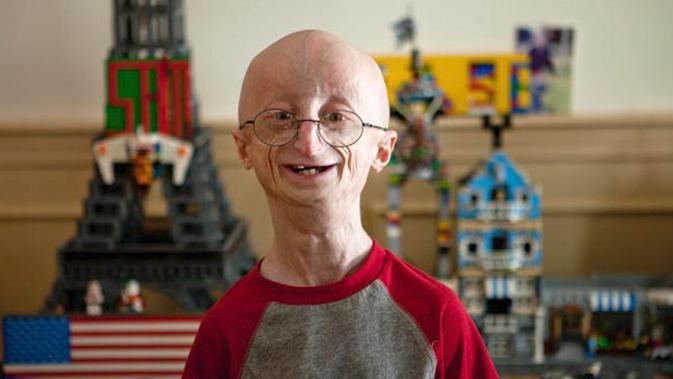 Progeria Si Kecil Dengan Muka Tua Karena Kelainan Genetis Health Liputan6 Com