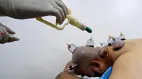 Spesialis melakukan pengobatan hijama atau terapi bekam basah kepada pasien di sebuah klinik di Ajman, Uni Emirat Arab, Kamis (15/8/2019). Hijama dianggap sebagai perawatan medis tradisional di negara-negara Islam. (KARIM SAHIB/AFP)