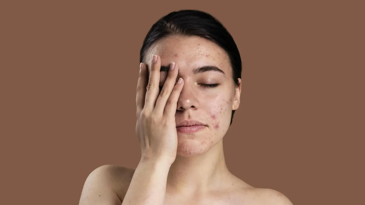 1. Membantu Mengatasi Jerawat dan Kulit Berminyak [Dok/freepik.com]