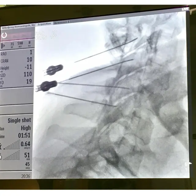 dokumentasi tindakan Neurolysis Ablation dengan Radiofrequency