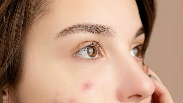 Atasi Bopeng Bekas Jerawat yang Bikin Tekstur Kulit Nggak Mulus, Begini Triknya!