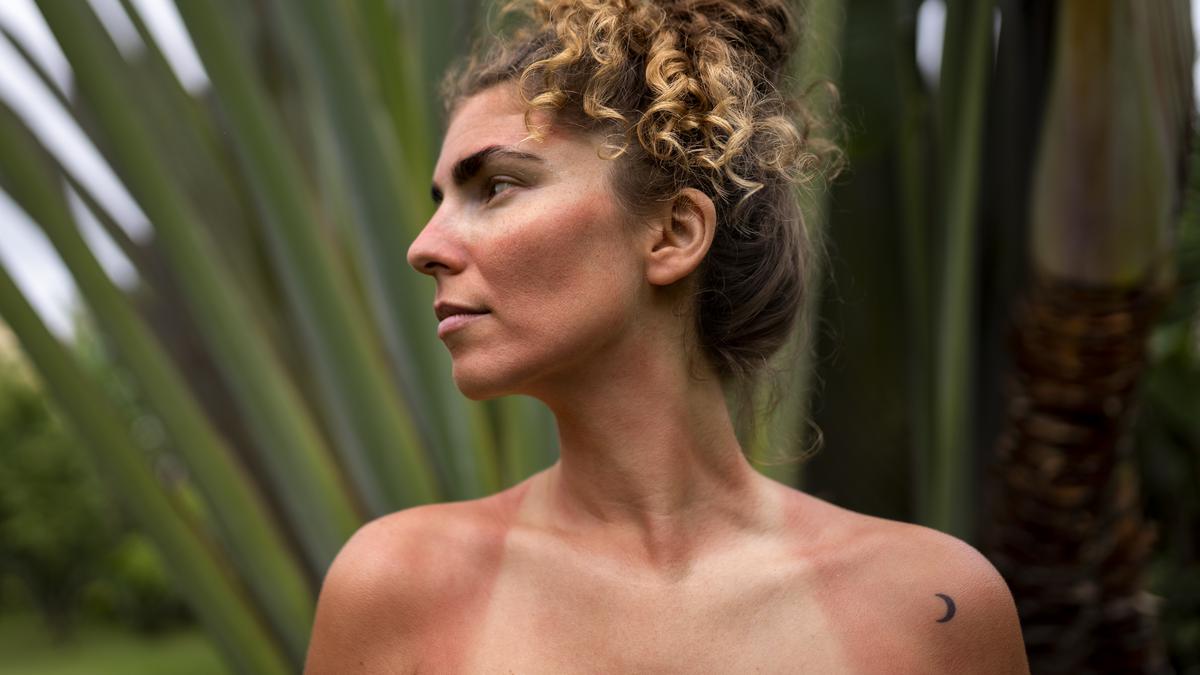 Cara Memulihkan Kulit yang Terkena Sunburn dengan Cepat