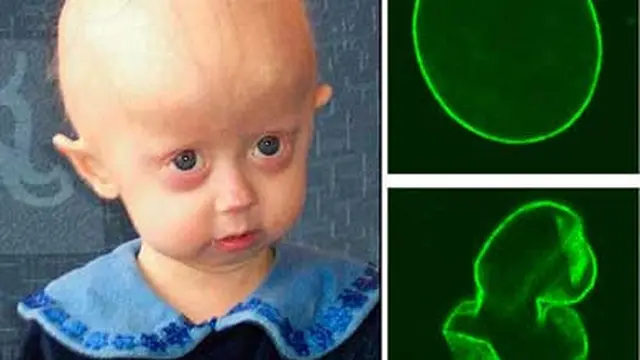 Penderita Progeria Kemungkinan Bisa Diobati