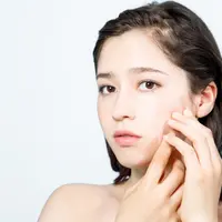 Ilustrasi jerawat/copyright shutterstock