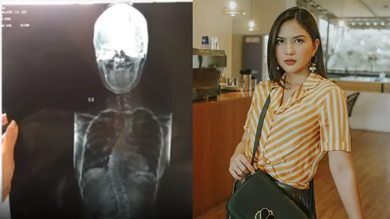 Akui Tak Malu Idap Skoliosis, Ini 6 Potret Jessica Mila saat Olahraga