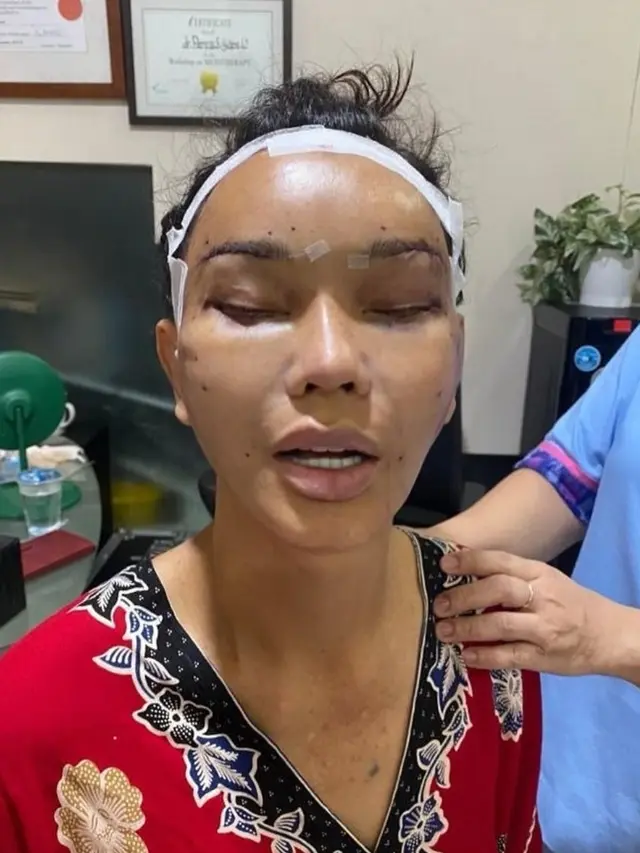 Wajah Bunda Corla Usai Oplas