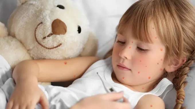 Demam dan Ruam pada Anak, Campak atau Cacar Air? (Africa Studio/Shutterstock)