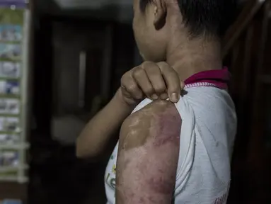 Foto yang diambil 13 Februari 2017 gadis berusia 14 tahun Khin Khin Tun menunjukkan bekas luka bakar di tangannya di Mawlamyine. gadis ini adalah korban perbudakan di Mawlamyine, sekitar 300 km sebelah tenggara Yangon, Myanmar. (AFP PHOTO/YE AUNG THU)