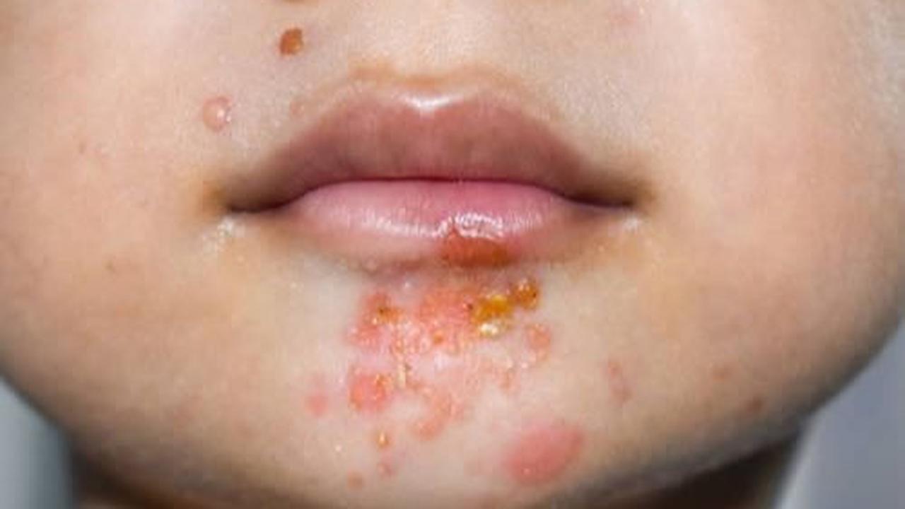 <b>3. Impetigo </b>