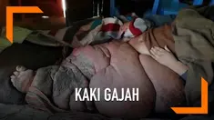 Pria asal Pakistan, Muhammad Mushtaq didiagnosis mengidap kaki gajah dengan berat kaki mencapai 133 kilogram. Muhammad meminta pemerintah untuk mengamputasi kakinya.