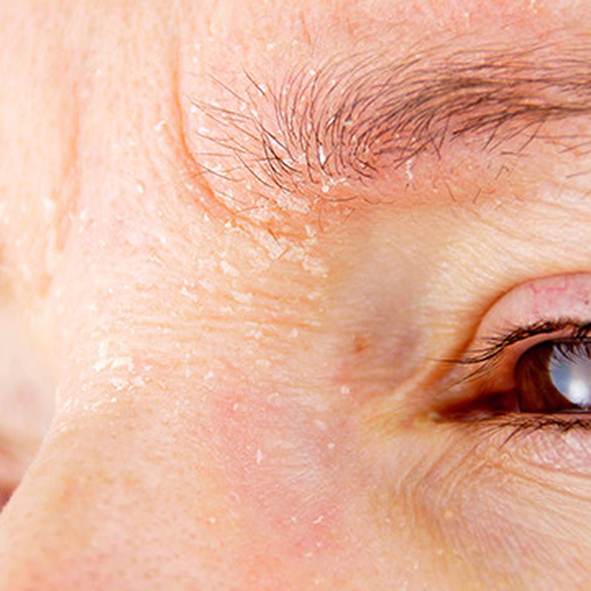 Wanita dengan dermatitis atopik
