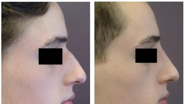 [Bintang] Berminat Tanam Benang? Coba Lihat Dulu Video yang Diunggah Oleh Dr Tompi Ini, Bikin Ngilu