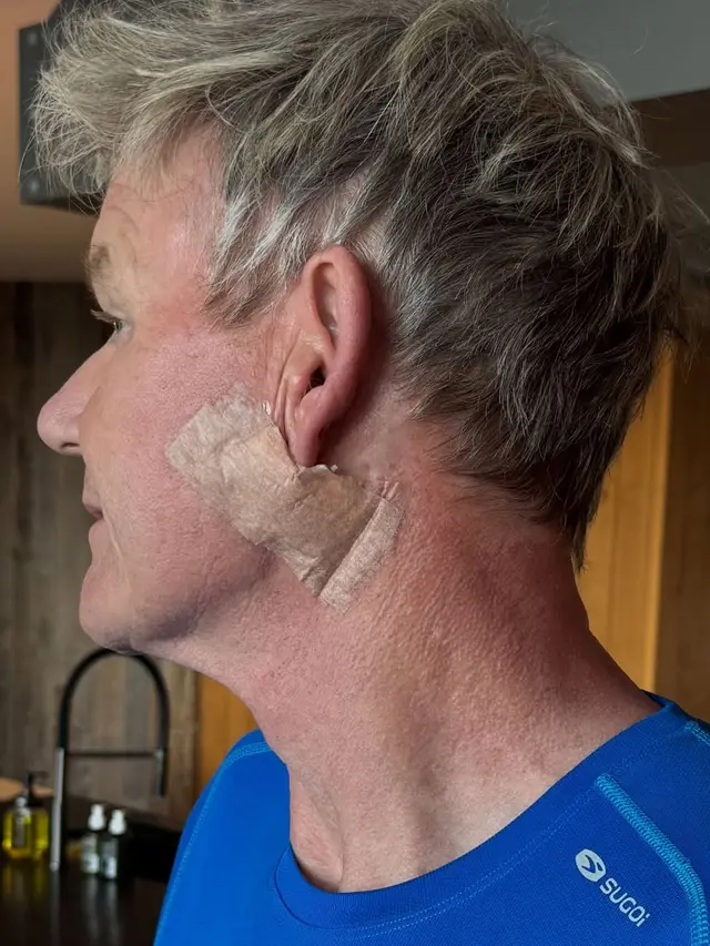 Chef Gordon Ramsay Ungkap Mengidap Kanker Kulit, Ingatkan Publik Rutin Pakai Sunscreen