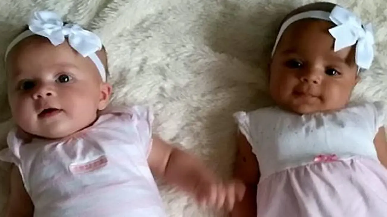 Langka, Bayi Kembar Ini Terlahir Beda Warna Kulit