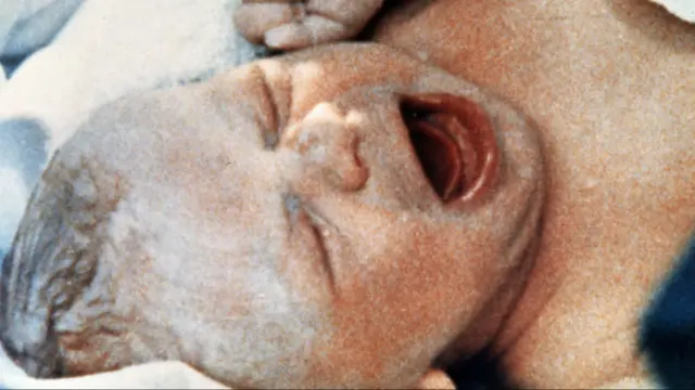 25-7-1978: Lahirnya Bayi Tabung Pertama di Dunia
