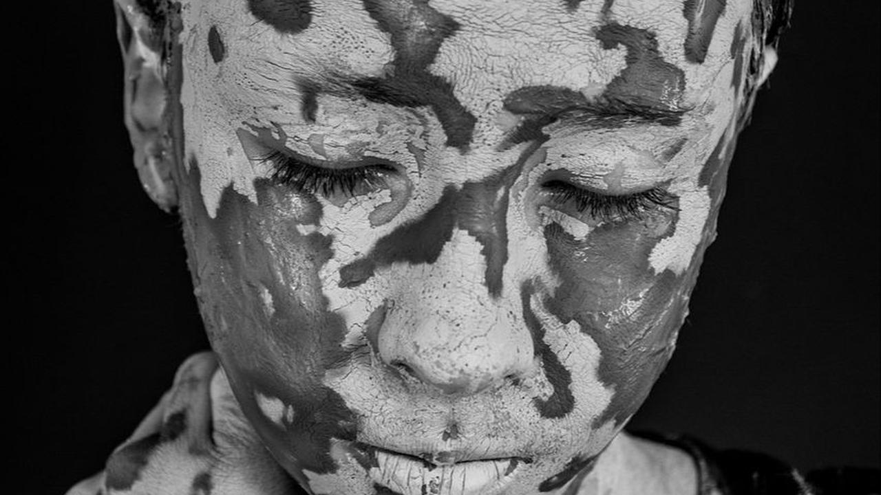 Pengertian dan Gejala Vitiligo