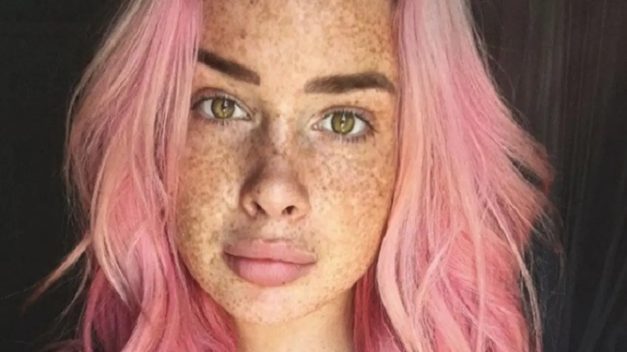 Punya Kulit Freckles, Wanita Ini Tetap Tampil Cantik 