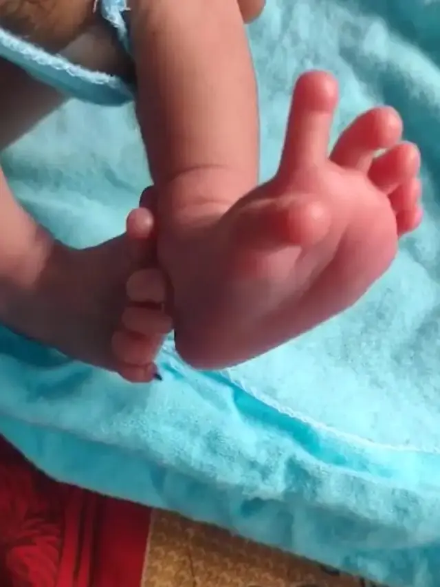 Bayi Perempuan di India Memiliki 26 Jari