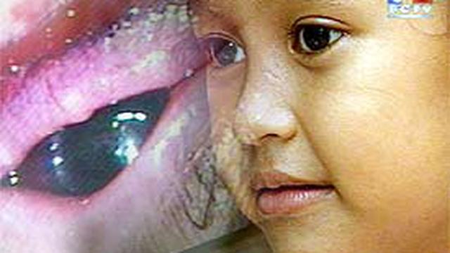 Waspadai Kelainan Bawaan Mata Anak News Liputan6 Com