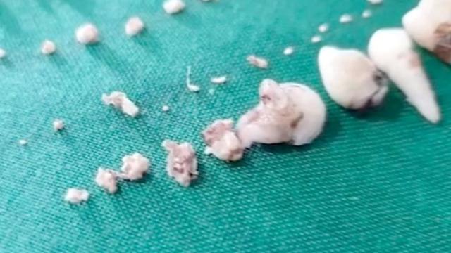 Mengeluh Sakit, 526 Gigi Ditemukan dalam Mulut Bocah 7 Tahun