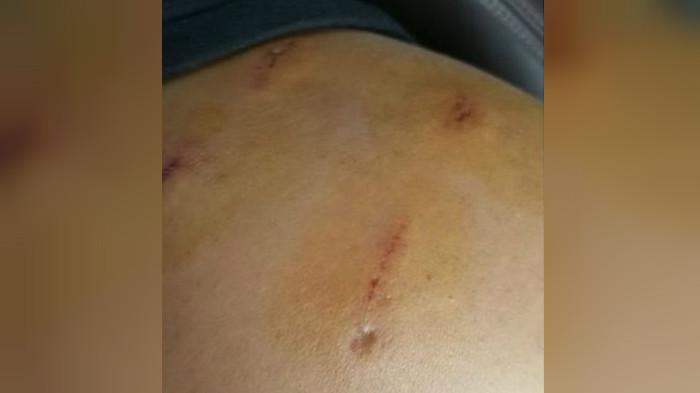 Bekas gigitan beruang di lengan Chen yang ia terima akibat nekat membuka jendela mobil di sebuah taman safari di China. (Weibo/Chen)