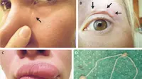 Benjolan yang bergerak di kelopak mata wanita ini rupanya berisi cacing parasit. (The New England Journal of Medicine)