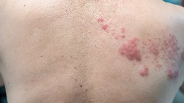 Cacar Api atau Herpes Zoster (Foto: Dok Istimewa)