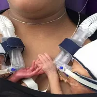 Lahir prematur, Kristian dan Kristiana tak ingin melepaskan tangan mereka satu sama lain.