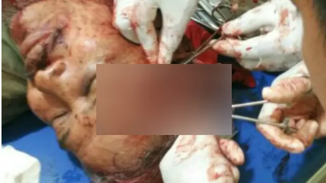 Orang Gila Bacok 3 Petani di Garut