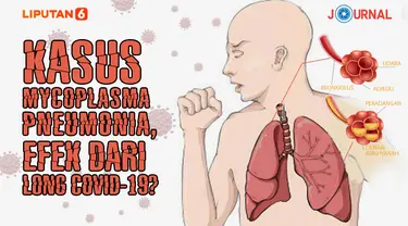 ilustrasi Kasus Mycoplasma Pneumonia, Efek dari Long Covid-19? (Liputan6.com/Abdillah)
