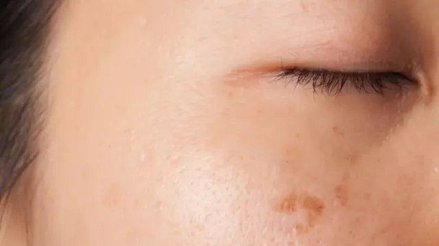 melasma