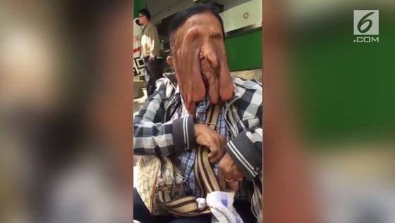VIDEO: Wajah Nenek Ini 'Meleleh' karena Penyakit Langka