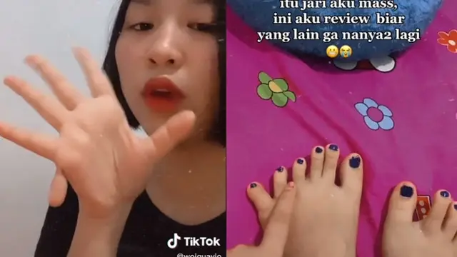 Viral Cerita Wanita Mengidap Kelainan Polidaktili, Punya 24 Jari Sejak Lahir