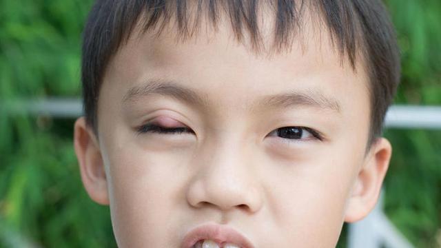 Apa Penyebab Anak Sering Bisulan?