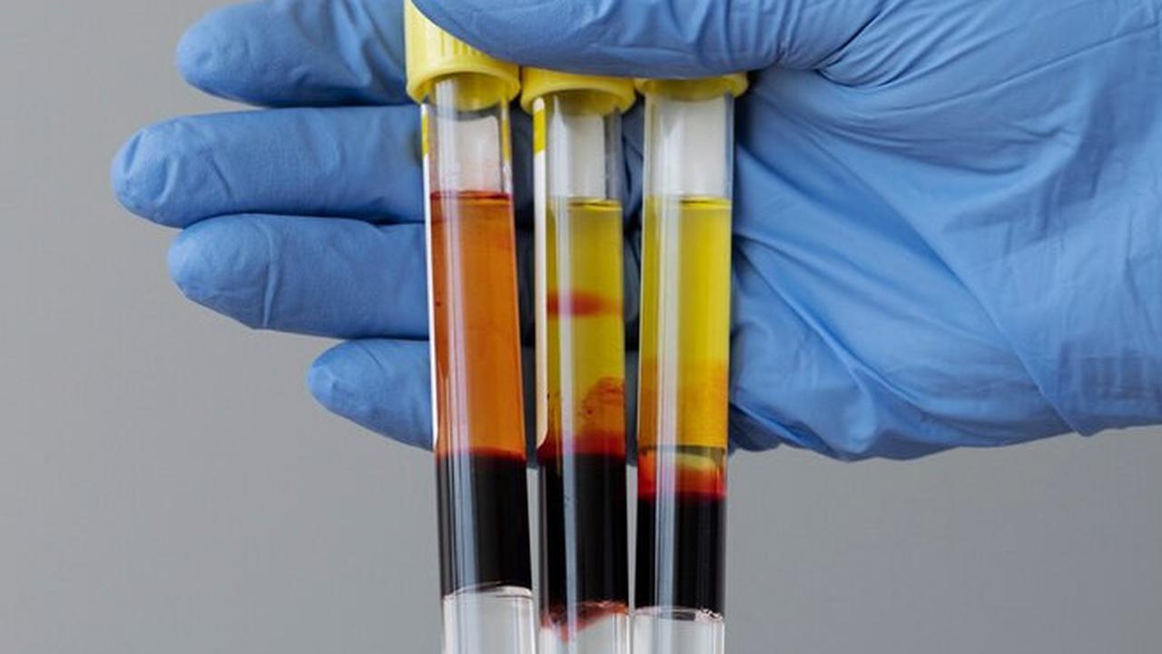 Waspadai Tanda-Tanda Asam Urat yang Dapat Terlihat di Urine Anda