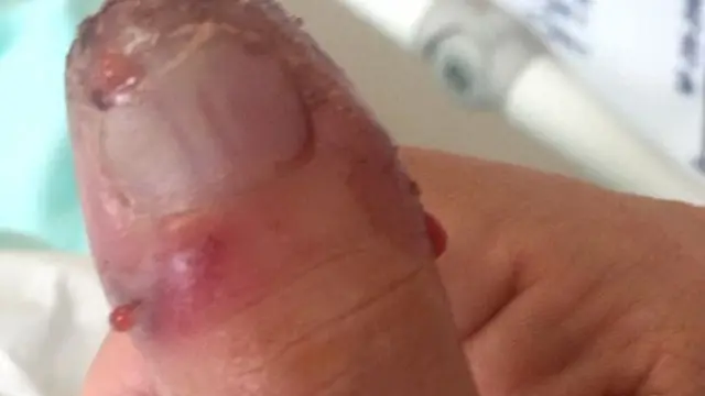 Akibat Luka Karena Cabut Kuku Palsu, Jempol Wanita Ini Diamputasi