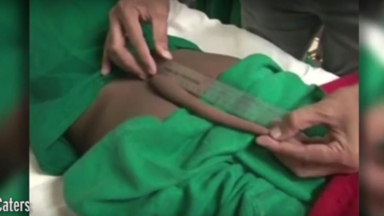 Terus Kesakitan, Ekor di Punggung Remaja Ini Akhirnya Diangkat