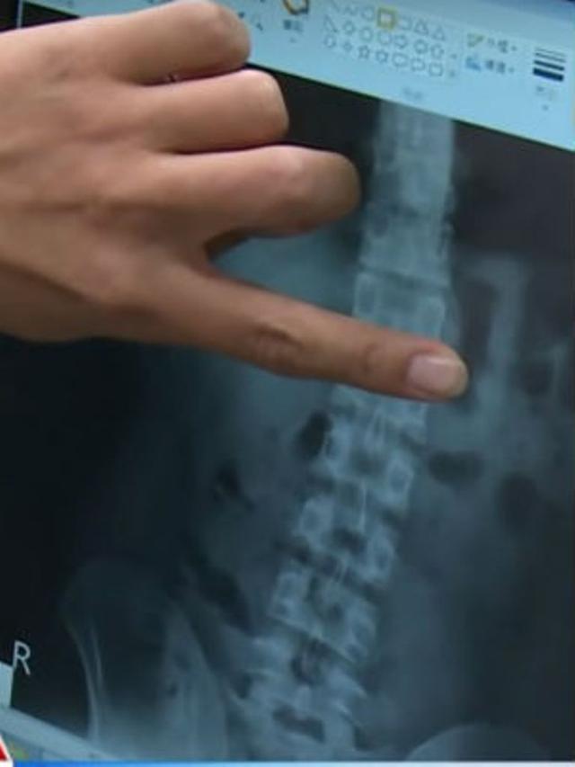 Dipakai Sambil Tidur, AirPod Pria Ini Tak Sengaja Tertelan