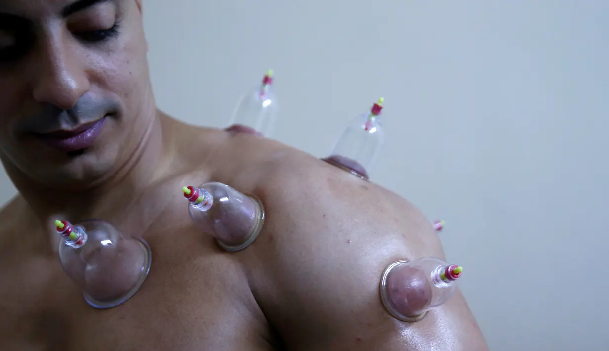 Atlet binaragawan Abdelrahman Ahmed menjalani Hijama atau terapi bekam di ruang perawatan medis Shubra El-Kheima, Kairo, Mesir, (13/08/2016). Pengobatan kuno yang menggunakan cangkir kaca membantu sirkulasi darah  (REUTERS/Amr Abdallah Dalsh).