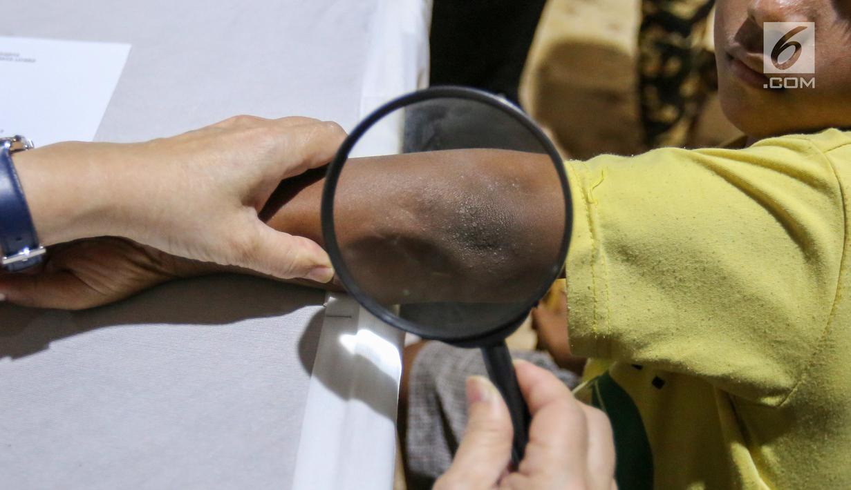 Dokter spesialis kulit memeriksa kulit pada pasien anak di komplek Rusunawa Muara Baru, Jakarta, Selasa (14/5/2019). Pemeriksaan kulit secara cuma-cuma merupakan program Vaseline Healing Project yang bertujuan meningkatkan perilaku hidup bersih dan sehat. (Liputan6.com/Fery Pradolo)