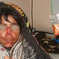 Belum diketahui apa motifnya, hidung seorang perempuan ditebas habis oleh suaminya sendiri.