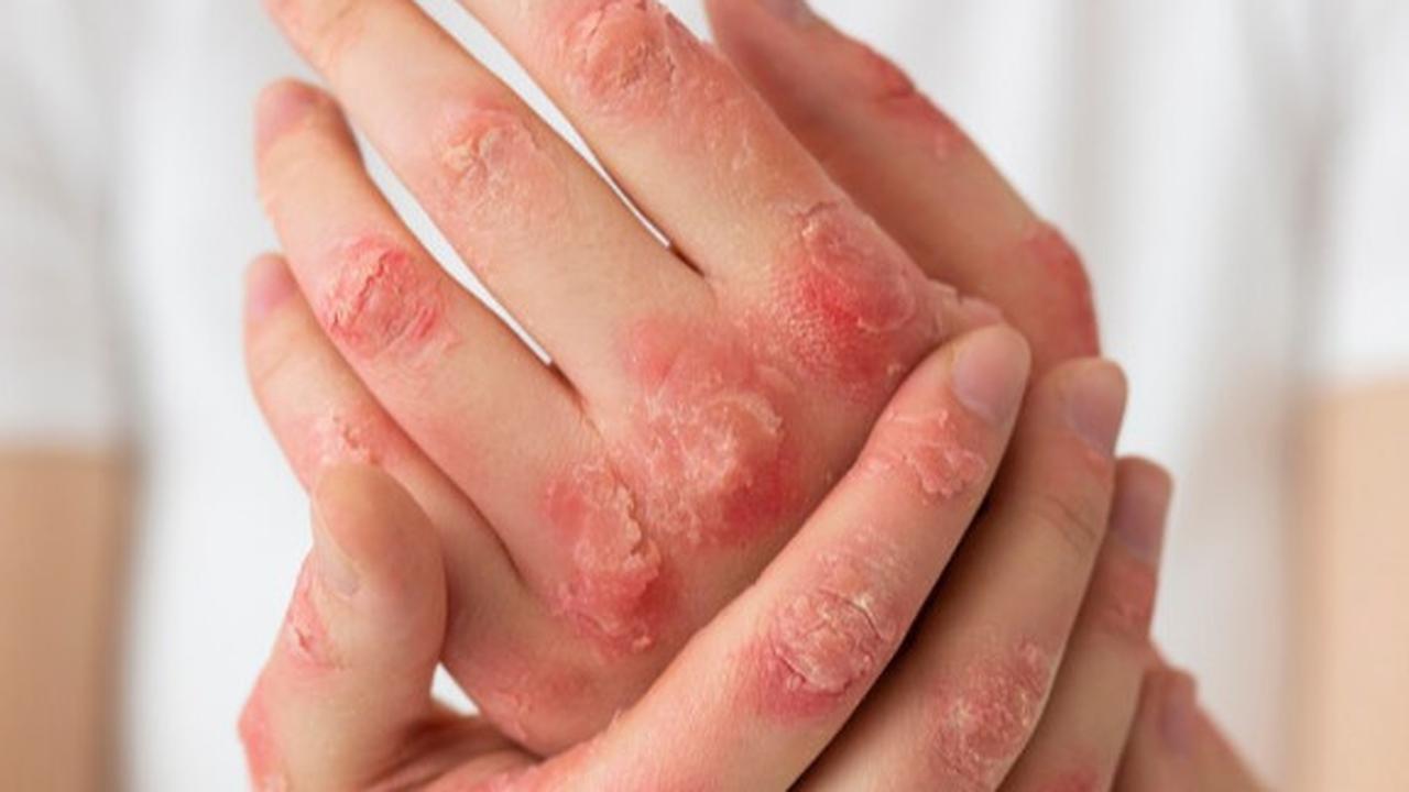 Steven Johnson Syndrome: Panduan untuk Pasien dan Keluarga dalam Proses Diagnosa