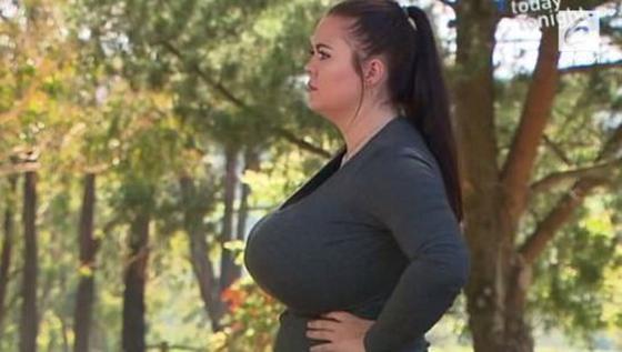 VIDEO: Payudara Berukuran K, Wanita Ini Terkena Skoliosis