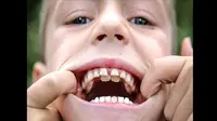 Biasanya gigi permanen akan tumbuh dan membantu mendorong keluar gigi bayi. Tapi hal itu tak terjadi pada Zak.